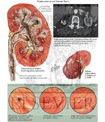 Image result for Genitourinary Tuberculosis