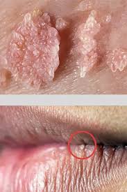 Image result for genital warts