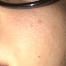 Ein peeling hilft gegen pickel am rücken. Pickelmale Wegbekommen Tipps Schule Gesundheit Und Medizin Beauty