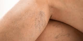 How Long Varicose Veins To Disappear After Laser Treatment