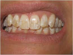 Fluorosis Is A Condition That Causes Poor Dental Tissues Quality And Tooth Darkening That Can Go From White Patches To Yell Discolored Teeth Teeth Yellow Teeth