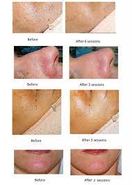Pores Reduction | Pores Tightening Treatment | Victoria Bc | Vancouver  Island