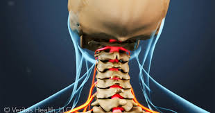 Neck Cracking And Grinding What Does It Mean Radiculopathy Cervical Radiculopathy Neck Cracking