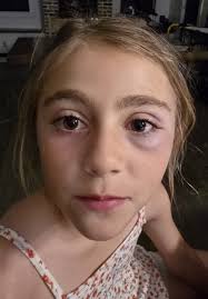 Support for Injured Umpire at Grand Blanc Softball Game