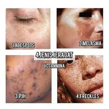 Cara menghilangkan jerawat dengan masker madu dan jeruk nipis. Beauty And Health Hakikatnya Utk Menghilangkan Jeragat Di Muka Kita Dgn Cara Selamat Dan Semulajadi Bknnya Senang Jika Anda Menggunakan Produk Murahan Atau Krim Timbang Kilo Yang Ada Merkuri Hydroquinone Tretonoin Dan