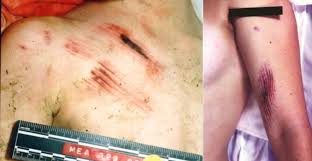 Résultat de recherche d'images pour "knife injuries"