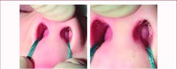 A flat, vertically oriented bony and cartilaginous partition located in the middle of the nose, which divides it into 2 lateral cavities, each ending in a nostril. Soft Fluctuant Swelling On Each Side Of The Nasal Septum In Keeping Download Scientific Diagram