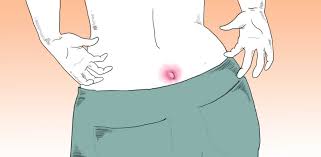 In this piece find out the possible causes of inward growing hair in buttcrack near the excretory opening, pictures, treatment, and prevention measures. Pilonidal Cyst Causes Treatment And How To Prevent Them Littlethings Com