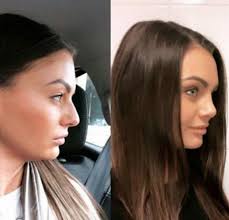 Love Island's Kendall Rae Knight surprises fans with nose surgery