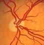 What causes optic nerve damage from www.specialtyeyeinstitute.com