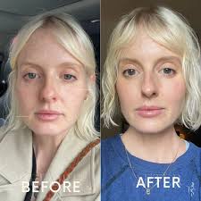 This isn't instant filler, it's collagen stimulation. Sculptra works  gradually to restore volume, improve skin quality, and create  natural-looking results that last. Subtle, refined, and designed to enhance  your features over time,
