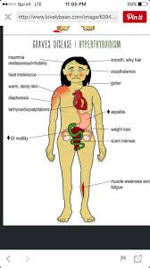 Graves' disease, the most common cause of hyperthyroidism, is associated with thyroid eye disease (ted), which can be treated with selenium. Pin On Health