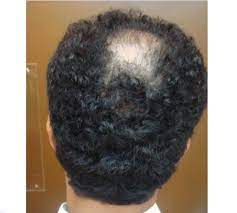 Usually, hair loss begins immediately after the appearance of a reason for this, and after a couple of weeks — a month. What Is Diffuse Patterned Alopecia Dpa And Its Treatment Hair Transplant Dubai