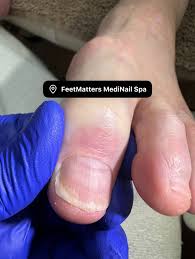Image result for Beau lines feet
