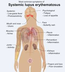 However, women get the disease more often than. Lupus Latest Facts Causes Symptoms And Treatments Gilmore Health News
