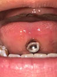 How to clean a tongue ring and faq. Does My Tongue Piercing Look Normal I Got It Pierced On The 6th Not Sure If I Should Scrape Away The Dead Skin There Or Leave It Piercing