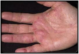 Rezultate imazhesh pÃ«r kanceri i penisit