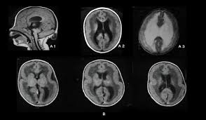It is caused by defective neuronal migration during the 12th to. Cobblestone Lissencephaly A Case 18 Axial And Sagittal T1 And Axial Download Scientific Diagram