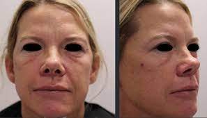 We did not find results for: Covid 19 Sars Cov 2 Virus Spike Protein Related Delayed Inflammatory Reaction To Hyaluronic Acid Dermal Fillers A Challenging Clinical Conundrum In Diagnosis And Treatment Springerlink