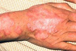 Lupus Erythematodes Variabel Wie Ein Chamaleon Pz Pharmazeutische Zeitung