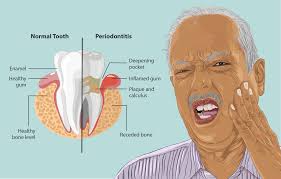 What help is there for periodontal disease? : r/PeriodontalDisease
