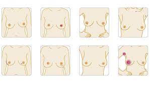 Breast cancer is the most common cancer in women, with an incidence that rises dramatically with age. Breast Cancer In Younger Women Breast Cancer Now