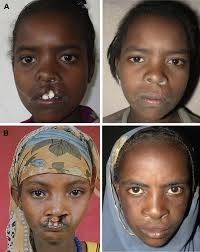 The impact of a single surgical intervention for patients with a cleft lip  living in rural Ethiopia