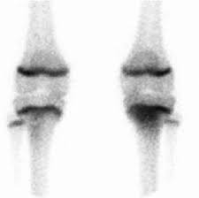 Image result for Osteomyelitis Bone Scan