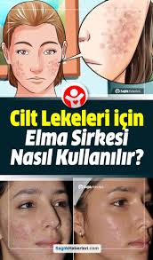 Cilt Lekeleri Icin Elma Sirkesi Nasil Kullanilir Cilt Bakimi Elma Sirkesi Elmalar Dogal Cilt Bakimi