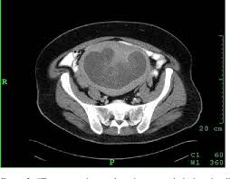 Ct scans can be used to detect. Figure 2 From A Case Of Asymptomatic Postmenopausal Hematometra Mimicking Endometrial Carcinoma Semantic Scholar