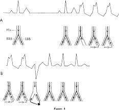 Typical vt (in contrast to fascicular vt) starts in. Pdf Supraventricular Tachycardia With Left Aberrant Conduction Due To Retrograde Invasion Into The Left Bundle Branch Semantic Scholar