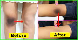 ↓ open this for more info ↓★hey guys! 14 Home Remedies To Get Rid Of Black Knees And Elbow