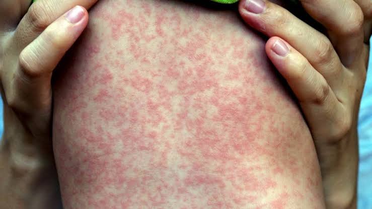 Viral Rash: Types, Pictures, Causes, and Treatments