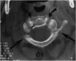 Check spelling or type a new query. Patologia Traumatica De La Columna Cervical Unidad De Neurocirugia Rgs