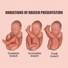 Image result for Breech Delivery