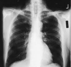 Plain radiograph · pleural opacity which may extend around and encase the lung · reduced volume of the affected hemithorax, resulting in ipsilateral shift of the . Malignant Mesothelioma With Osseous Differentiation The Annals Of Thoracic Surgery