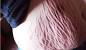 Infected Ingrown Hair On Stretch Mark