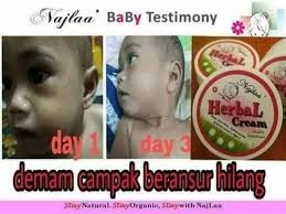 Terlebih lagi jika penyakit campak menyerang pada anak maka para orangtua dihimbau supaya membatasi. Set Rawatan Demam Campak Shopee Malaysia