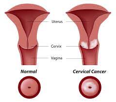 Ignoring symptoms may allow the cancer to grow to a more advanced stage and lower your chance for. A Patient S Guide To Cervical Cancer By Dr Indu Bansal Onco Com