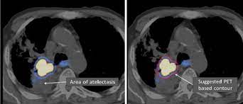 6715 n charles st baltimore, md 21204 : Pet Ct Imaging For Target Volume Delineation In Curative Intent Radiotherapy Of Non Small Cell Lung Cancer Iaea Consensus Report 2014 Radiotherapy And Oncology