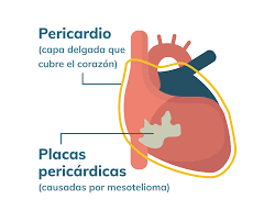Mesothelioma que significa en español. Que Es Mesotelioma Sintomas Pronostico Y Tratamiento