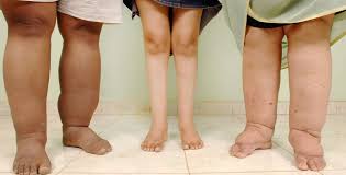 Elephantiasis Extreme Schwellungen Durch Lymphstau