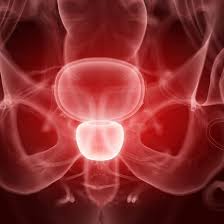 This is for colon cancer, which affects both men and women. Early Detection Of Prostate Cancer And Alternative To Invasive Biopsies Healthcare In Europe Com