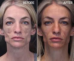 Before and after treatment photos from advanced dermatology & skin cancer center in northwest arkansas. Sculptra Riversidemedicalarts Com