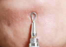 Deep, inflamed pimples how it works: Pimple Popping 101 How To Get It All Out Cleanly With Less Damage To Skin Project Vanity