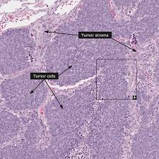 Lung cancer begins in the lungs and may spread to lymph nodes or other organs in the body, such as the brain. Dictionary Cancer Lung Cancer The Human Protein Atlas