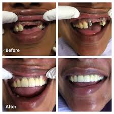 Fortunately, dental implants are very safe and it is rare that anything goes wrong. Single Tooth Dental Implant Ottawa Front Tooth Replacement