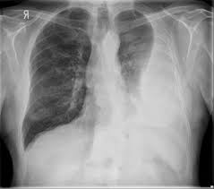 Loss of right diaphragmatic and cardiac silhouettes. Malignant Pleural Effusion Pulmonology Advisor