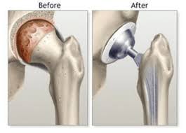 4 you may also experience symptoms like mild swelling and limited mobility. Direct Anterior Approach To The Hip Midwest Center For Joint Replacement Hip And Knee Replacement Surgeons