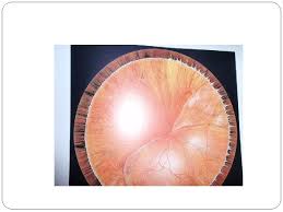 This type of retinal detachment occurs as a result of accumulation of fluid within the retina due to abnormalities in the retina's blood flow and ability to transport water. Retinal Detachment Presentation And Principle Of Management By